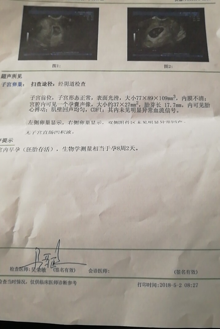 子宫腺肌症_子宫肌腺症 子宫腺肌症_子宫腺肌症症如何受孕