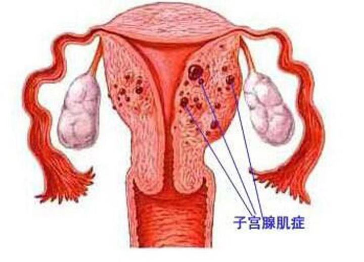 子宫腺肌症_子宫腺肌症症如何受孕_子宫肌腺症 子宫腺肌症