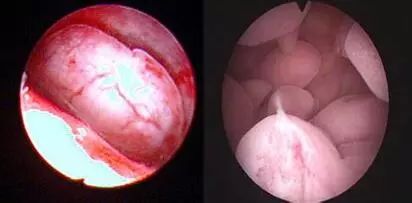 宫腔环境检查_宫腔镜检查?_宫腔镜检查
