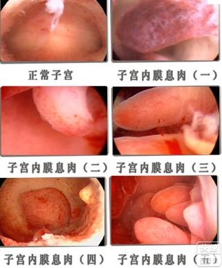 宫腔镜检查_宫腔环境检查_宫腔镜检查?