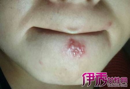 单纯疱疹病毒的治疗方法_单纯疱疹病毒_呼吸道病毒 单纯疱疹