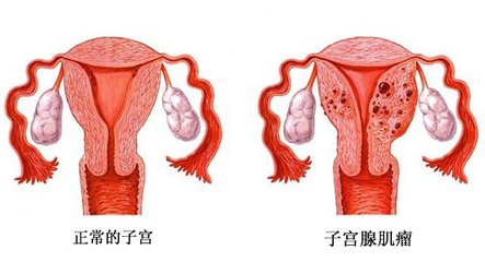 子宫腺肌症的治疗_子宫腺肌症症怎么怀孕_子宫腺肌症