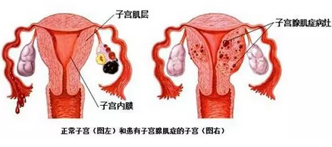 子宫腺肌症症怎么怀孕_子宫腺肌症_子宫腺肌症的治疗