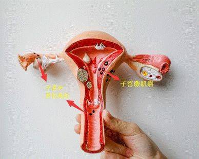 子宫腺肌症_子宫腺肌症症怎么怀孕_子宫腺肌症的治疗