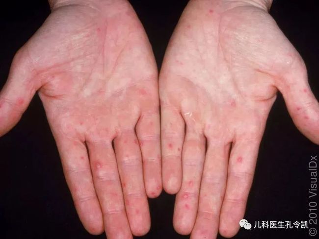 单纯疱疹_单纯疱疹病毒_单纯疱疹病毒感染