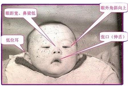 唐氏综合症