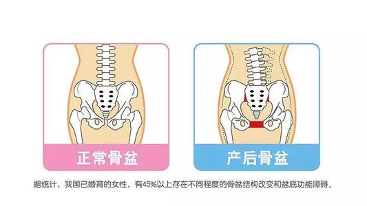 盆底肌修复_盆底肌康复治疗_产后康复盆底肌