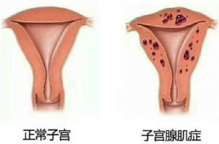 子宫腺肌症子宫腺肌瘤_子宫腺肌症_子宫腺肌症症如何受孕