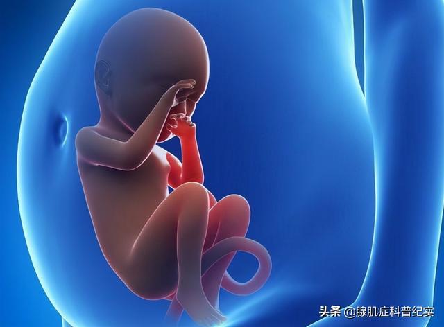 子宫腺肌症_子宫腺肌症与腺肌瘤_子宫肌腺症 子宫腺肌症