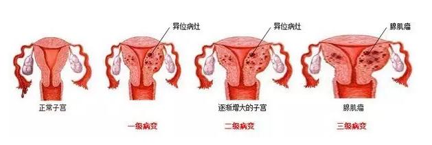 子宫腺肌瘤 子宫腺肌症_子宫腺肌症_子宫腺肌症与腺肌瘤