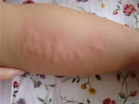 幼儿急疹_幼儿急疹的症状与治疗_幼儿急疹症状