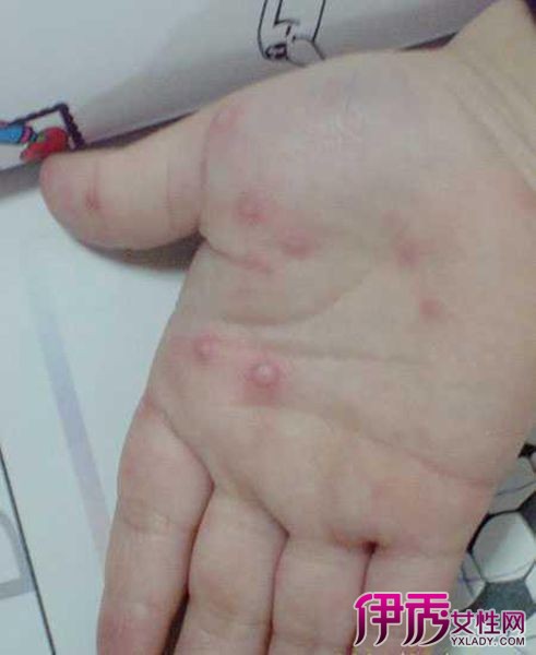 幼儿急疹的症状与治疗_幼儿急疹症状_幼儿急疹