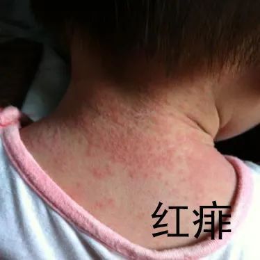 幼儿急疹_幼儿急疹症状_幼儿急疹的症状与治疗