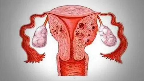 子宫腺肌症子宫腺肌瘤_子宫腺肌症与腺肌瘤_子宫腺肌症
