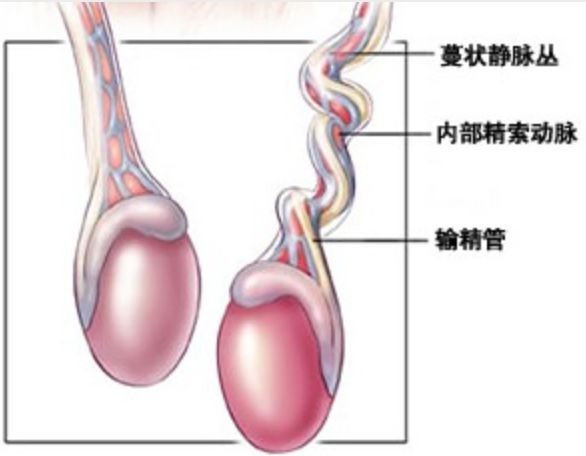 睾丸扭转诊断_睾丸扭转_睾丸扭转坏死