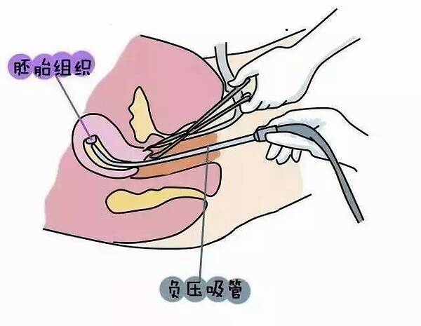 宫腔环境检查_宫腔镜检查?_复兴医院宫腔镜检查