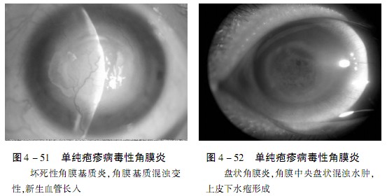 单纯疱疹病毒_单纯疱疹病毒感染_呼吸道病毒 单纯疱疹