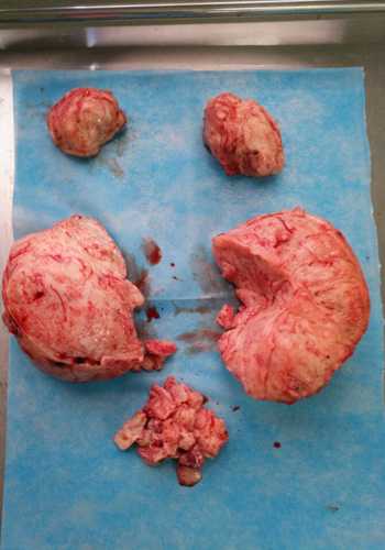 子宫腺肌症怎么治疗_子宫腺肌症症如何受孕_子宫腺肌症