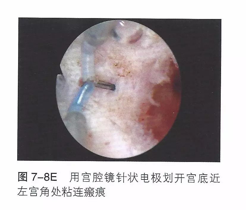 宫腔粘连_单腔造瘘和双腔造瘘_宫颈口粘连扩宫
