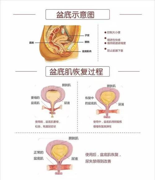 盆底肌康复治疗_盆底肌修复_盆底肌康复训练