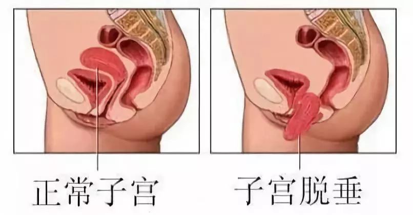 盆底肌修复