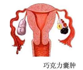可拉奥巧克力榛子瓦巧克力夹心蛋卷_皮样囊肿或皮脂腺囊肿图片_巧克力囊肿