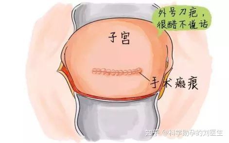多胎妊娠