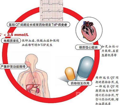 长QT间期综合征