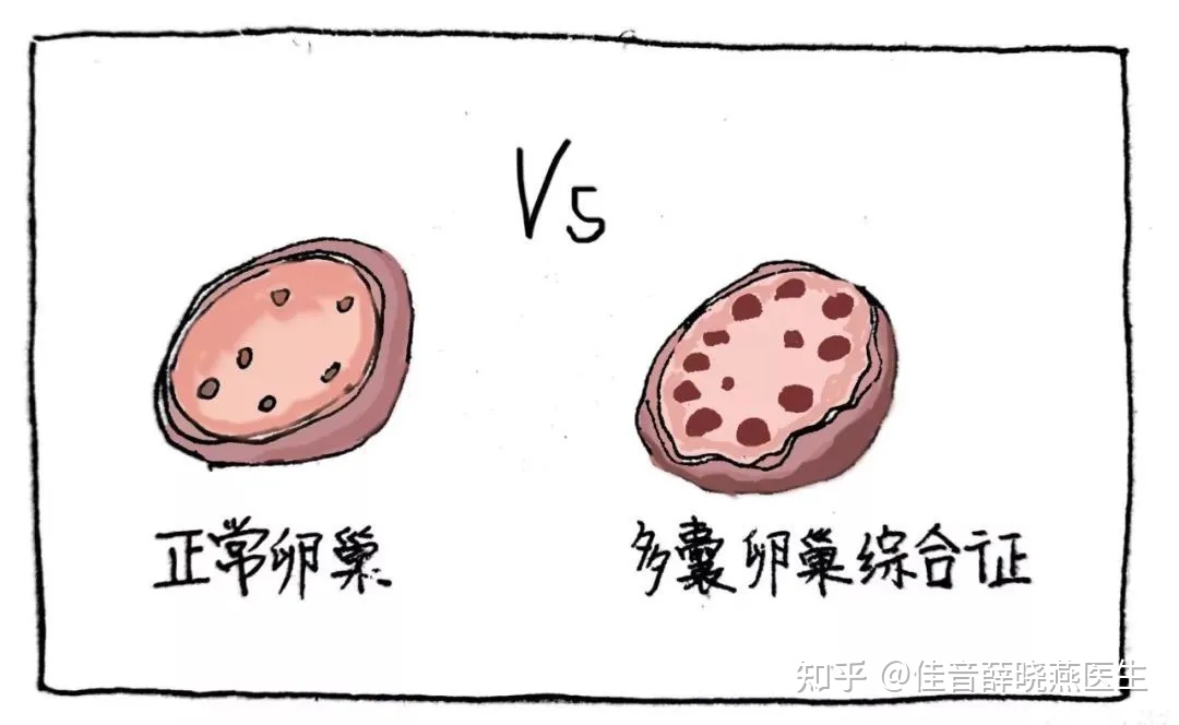 多囊卵巢