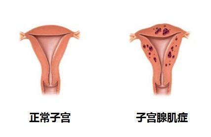 子宫腺肌症子宫腺肌瘤_子宫腺肌症_什么是子宫腺肌症