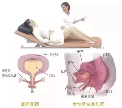 盆底肌修复