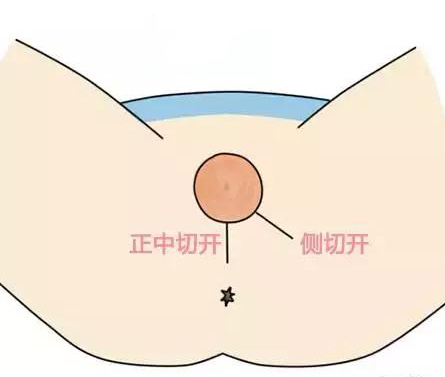 侧切