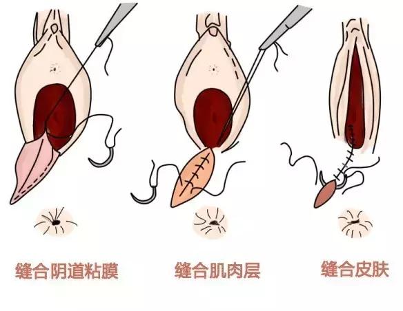 侧切