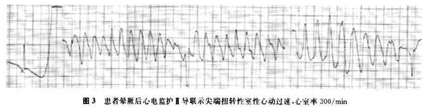 长QT间期综合征