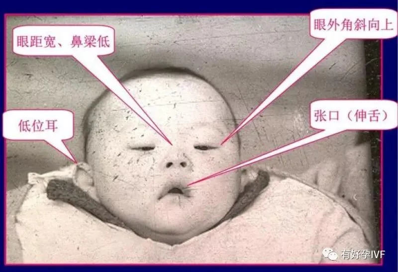 唐氏筛查综合值是1::425,参考值是1:250_唐氏综合症_囤积症对应的是什么症