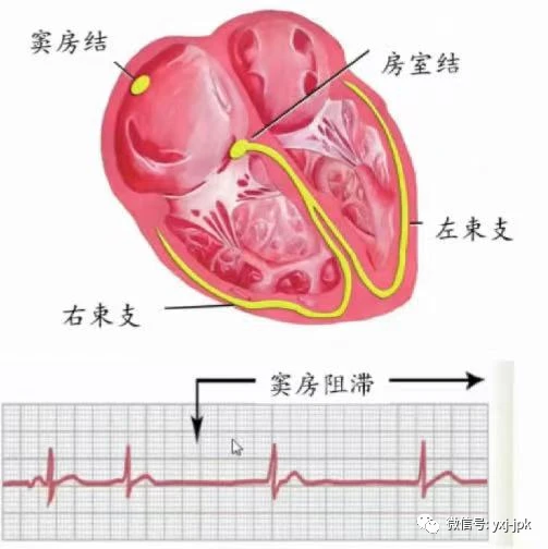 长QT间期综合征