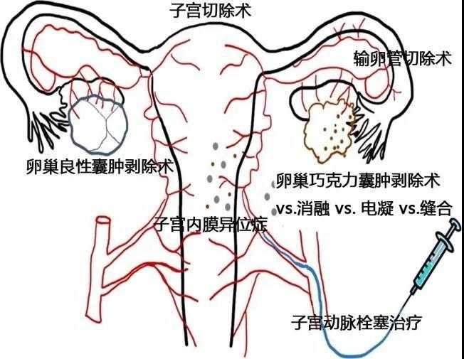 卵泡与卵泡囊肿_窦卵泡计数_有卵泡不排卵泡会变成什么
