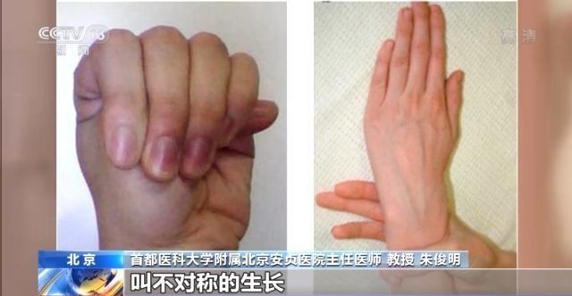 马凡氏综合症