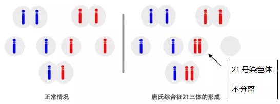 唐氏综合筛查是什么_唐氏综合症_先天愚型 唐氏综合