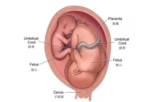 多胎妊娠减胎_多胎妊娠_足月妊娠胎心率