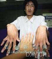 马凡氏综合症