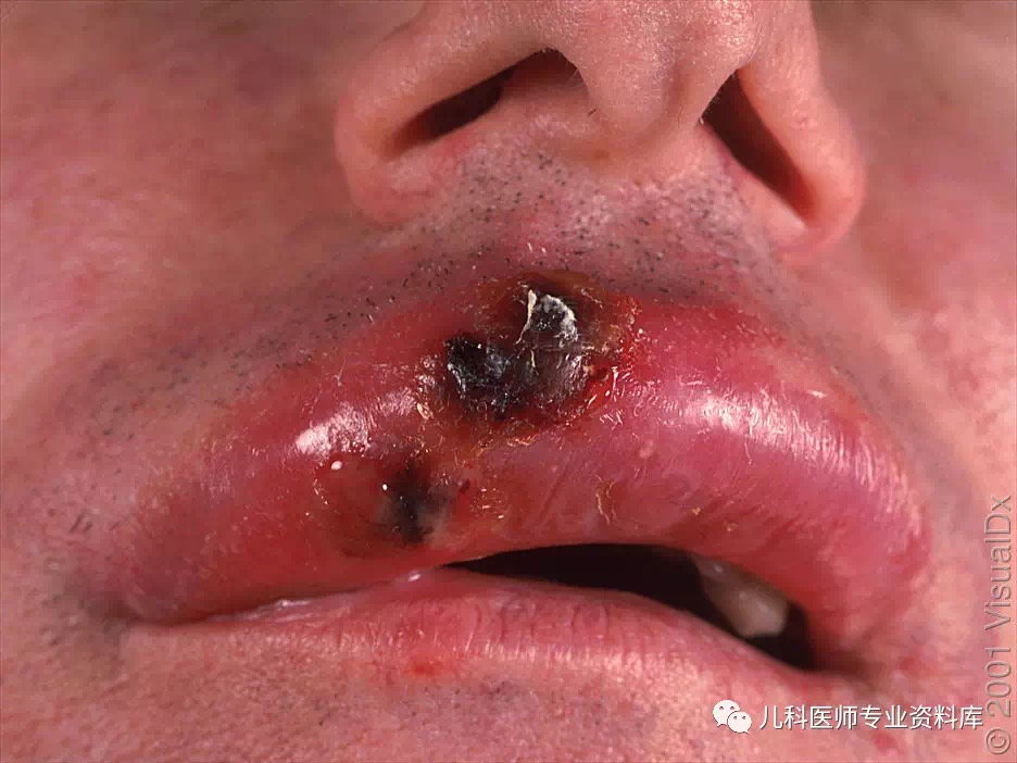 单纯疱疹病毒