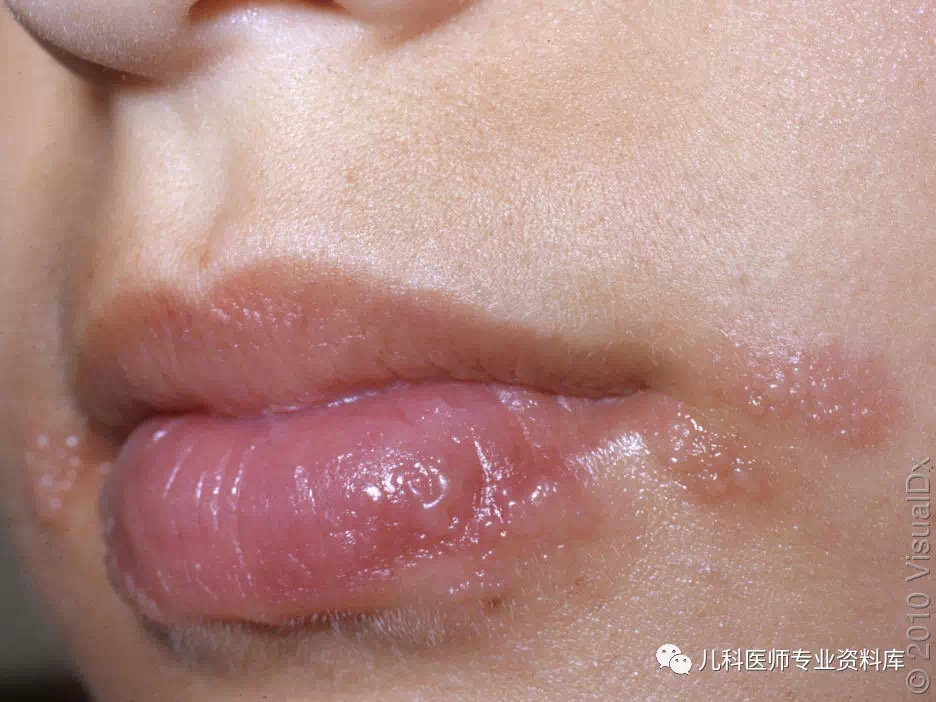 单纯疱疹病毒