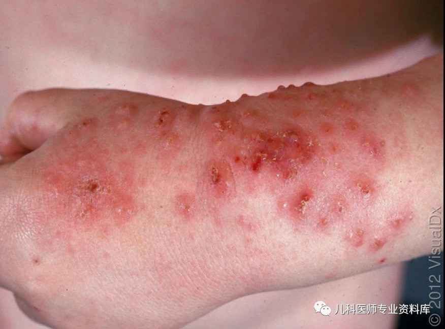 单纯疱疹病毒