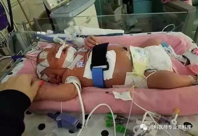 单纯疱疹病毒