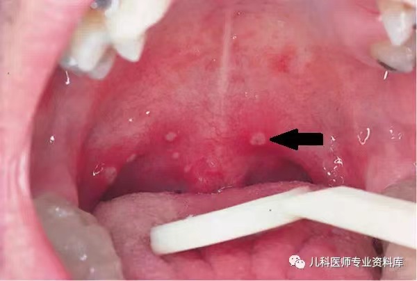 单纯疱疹病毒