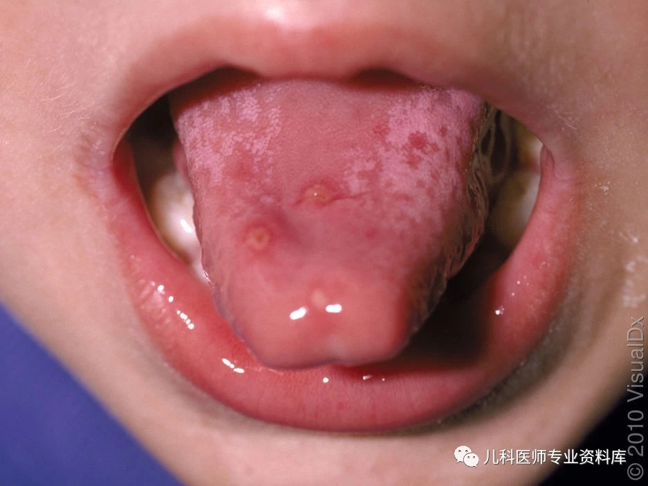 单纯疱疹病毒