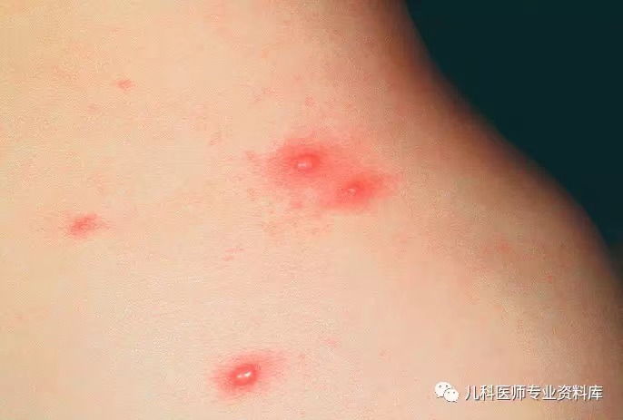 单纯疱疹病毒