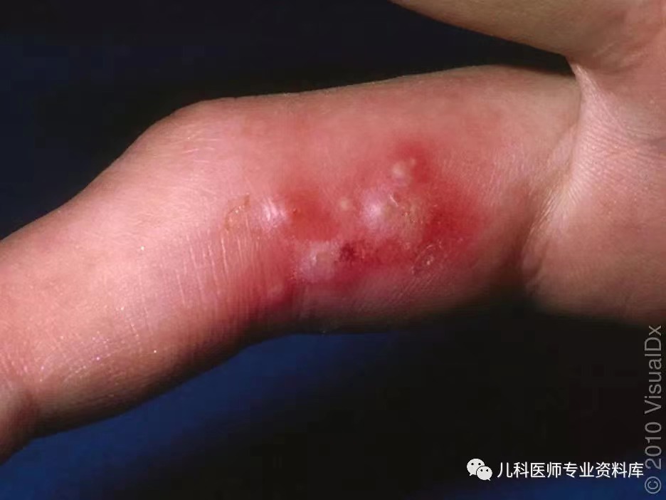 单纯疱疹病毒