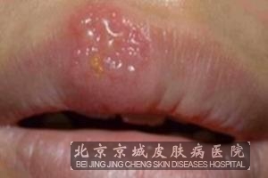 阴部单纯疱疹_单纯疱疹病毒_单纯疱疹病毒性脑炎